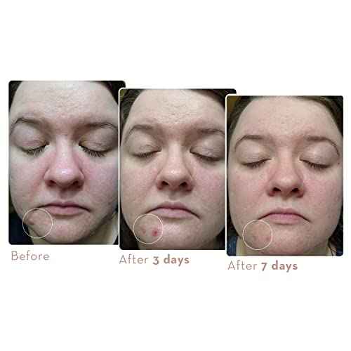 Sonage Zitlox Salicylic Acne Gel: Spot Treatment with Tea Tree Oil | Clears Acne Blemishes | Benzoyl Peroxide Alternative