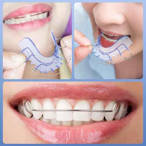 2 Hawley Retainers for Custom Teeth Retention ? Comfortable & Durable Upper and Lower Retainers, Custom-Fit for Adults & Kids