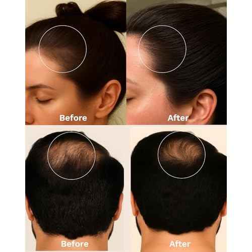 Keyoma Batana Oil for Hair Growth with Rosemary: Nourish & Detox Scalp for Thicker, Stronger, Longer Hair - 100% Organic Batana Oil from Honduras - Reduce Hair Loss (90 mL)