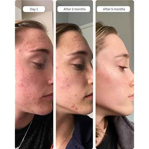 Averr Aglow Clear Skin Elixir, Face Mask Prevent Breakouts, Clear Acne & Oily Skin, Fade Scars Marks, Natural Skincare Solution, Reducer & Pores Cleanser Treatment, Natural Younger Looking Skin