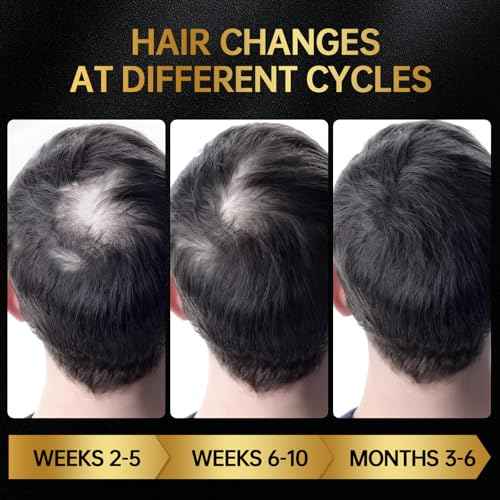Minoxidil for Men & Women, With Biotin, Batana Oil, Rosemary Essential Oil, Effective Hair Loss Solution, Hair Loss Treatment for Hair Regrowth, Non-Greasy 5% Minoxidil - 60ml(Single Bottle Serum)