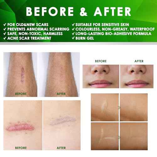 Tobcharm Advanced Keloid Bump Removal Gel, Silicone Scar Removal Cream for Keloid Treatment, Piercing Bumps, Acne Scars, Surgical Marks & Burns, Scar Gel for Ears, Face & Body 2-Pack (2¡¿30g)