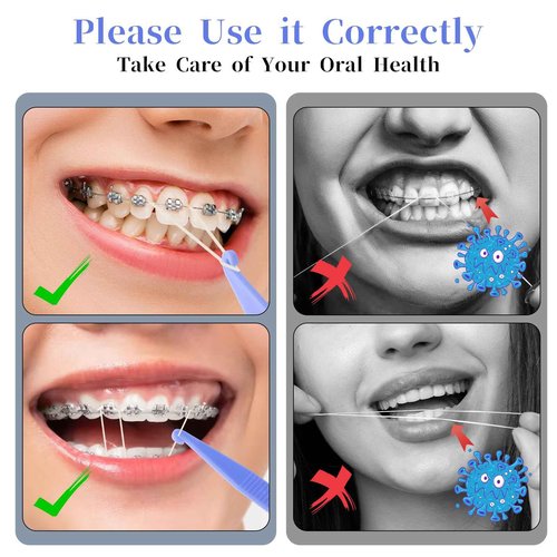 simarro 500Pcs Orthodontic Elastic Rubber Bands, Teeth Rubber Band with 5 Pieces Placers for Braces Dental Tools for Fix Tooth Gap, Braces, Crooked Teeth