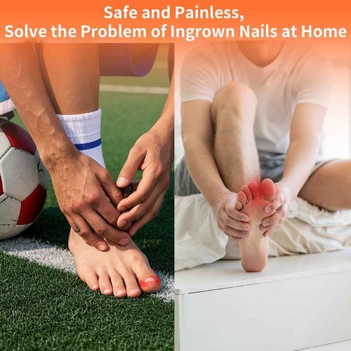 5 Sizes, 10 Pcs - Ingrown Toenail Treatment Kit, Titanium Alloy Ingrown Toenail Removal Kit, Nails Corrector Tool & Remover Strips - Ingrown Toe Nail Quick Relief(0.51/0.59/0.67/0.7/0.74 inches)