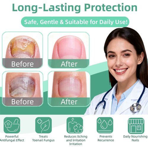 Nail Fungus Pen,Nail Growth & Repair Essence Pen, specifically designed for fungal infections on toenails and fingernails. Repairs and strengthens nails, revealing smooth and glossy nails(3pcs)