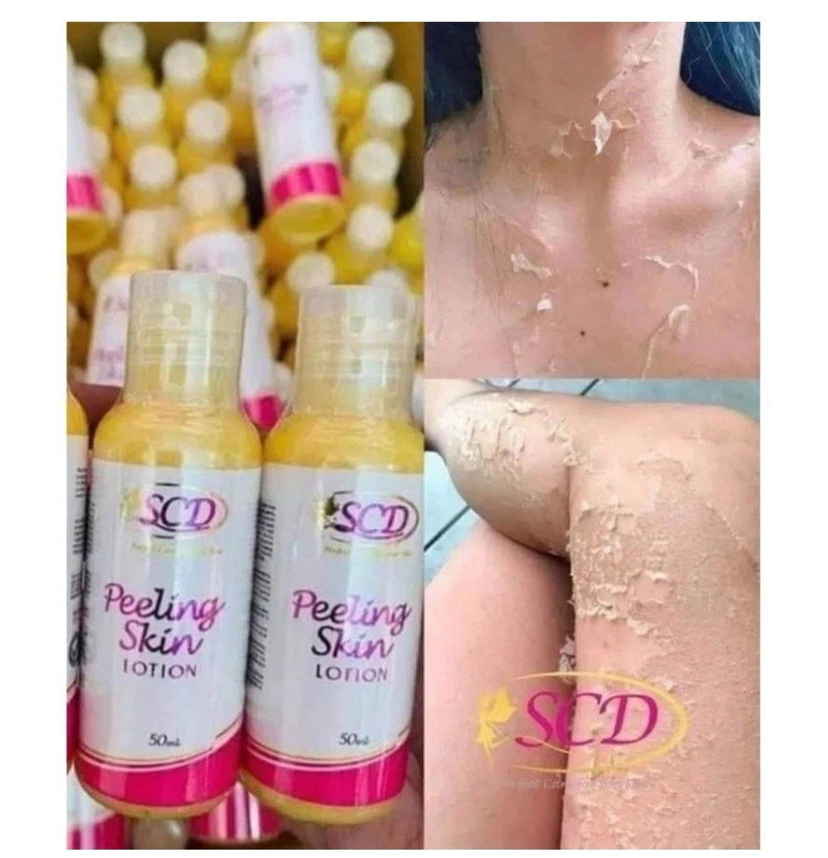 Skin Peeling Lotion for Dark Spots & Stretchmarks - 100ml