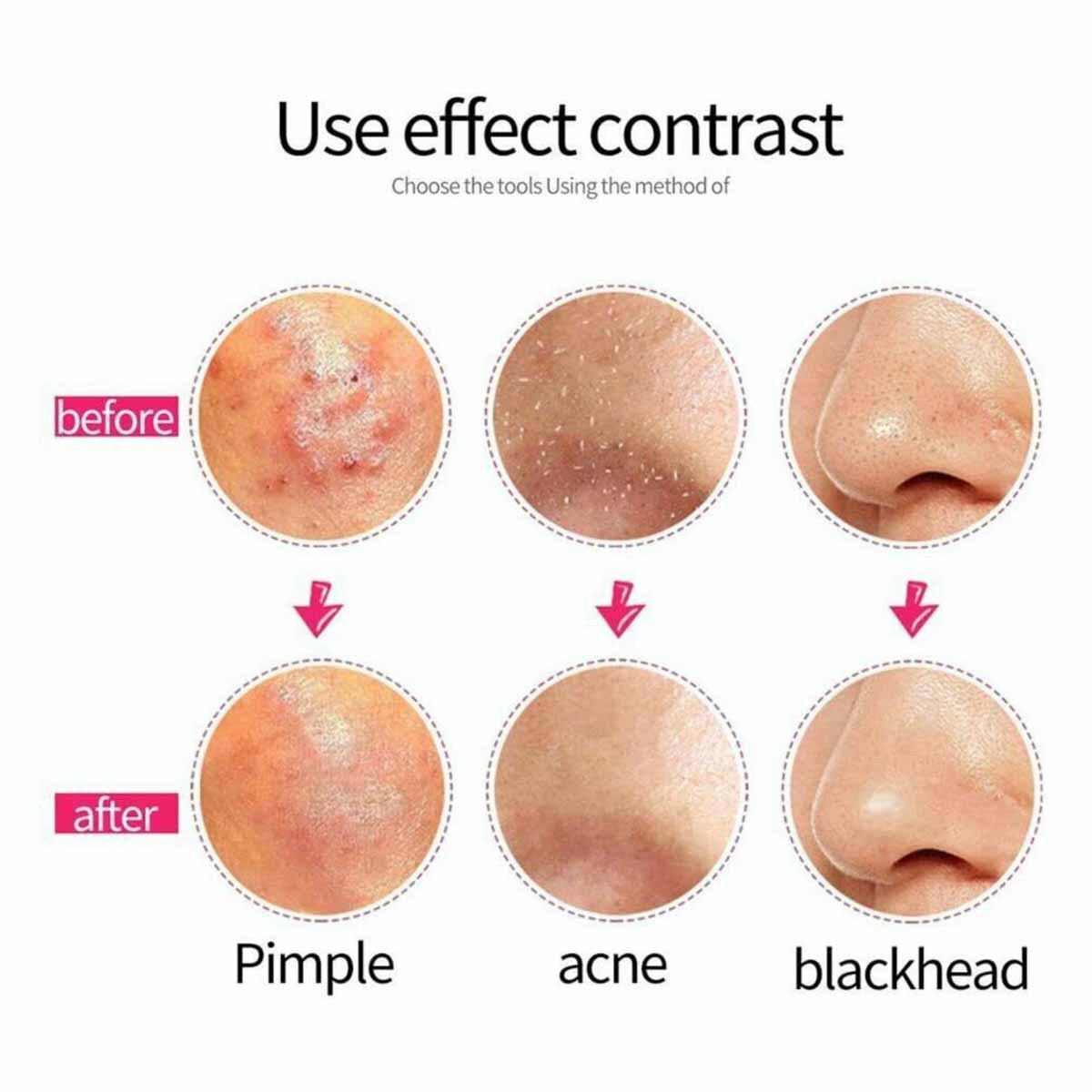Blackhead & Pimple Extractor Kit - 9 Pcs Professional Skin Care Tools