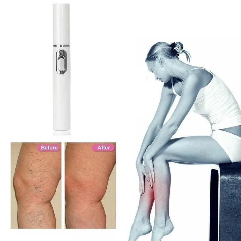 Laser Wart Remover Pen - Pain-Free Skin Tag and Mole Removal Device