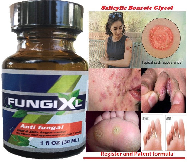 Antifungal Salicylic Acid Gel for Feet, Nails & Hands