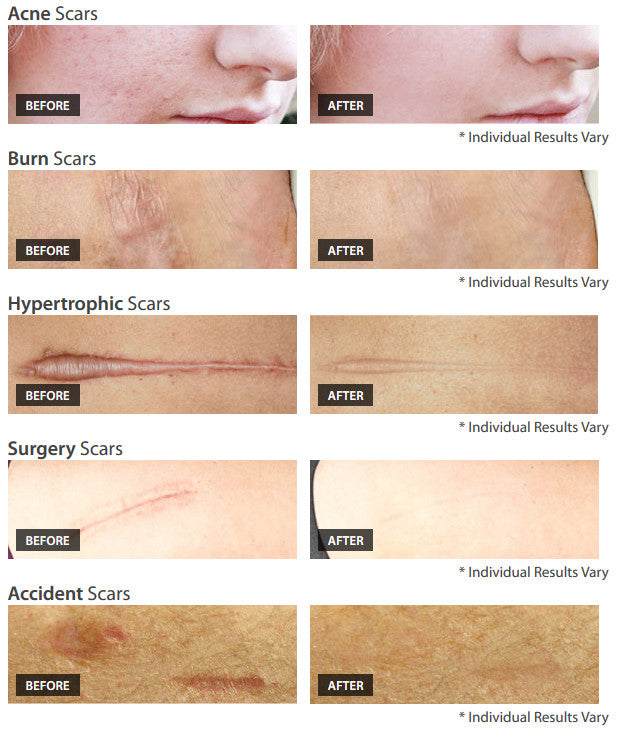 Dermefface FX7 Scar Reduction Therapy - 0.5 oz