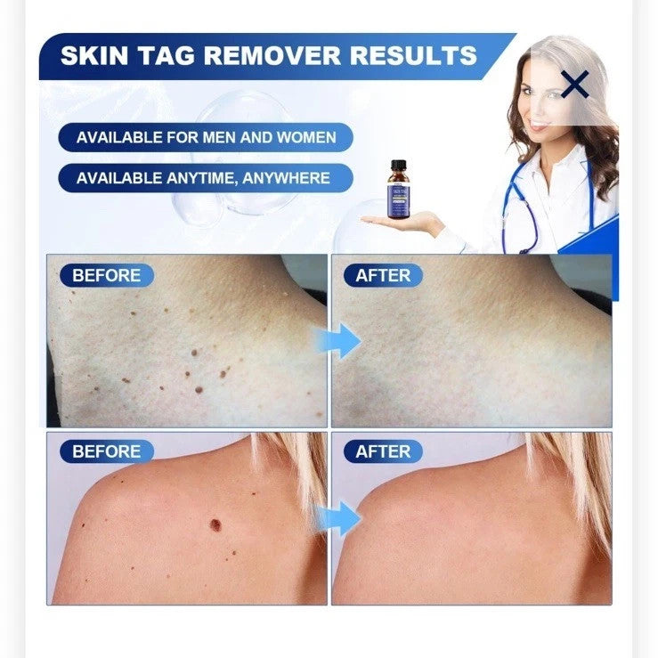 Skin Tag Remover 30mL Max Formula - Fast-Acting Skin Care Solution (2 Pack)
