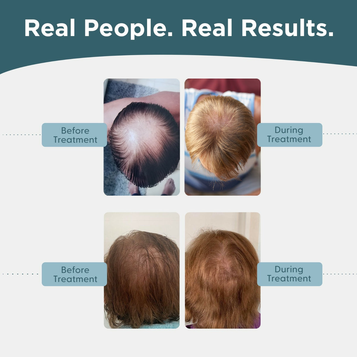 Minoxidil 5% Topical Solution for Men Hair Regrowth