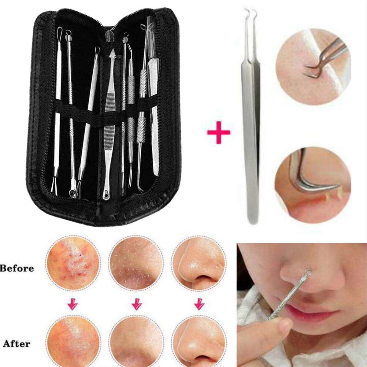 9Pcs Blackhead Remover Tool Kit - Stainless Steel Comedone Acne Extractors