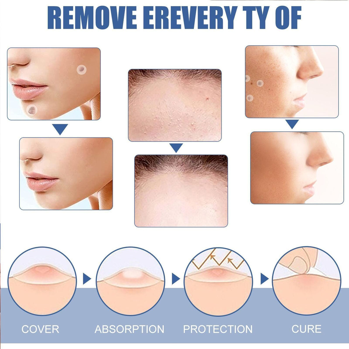 144PCS Skin Tag & Acne Remover Patches Hydrocolloid Wart & Pimple Treatment