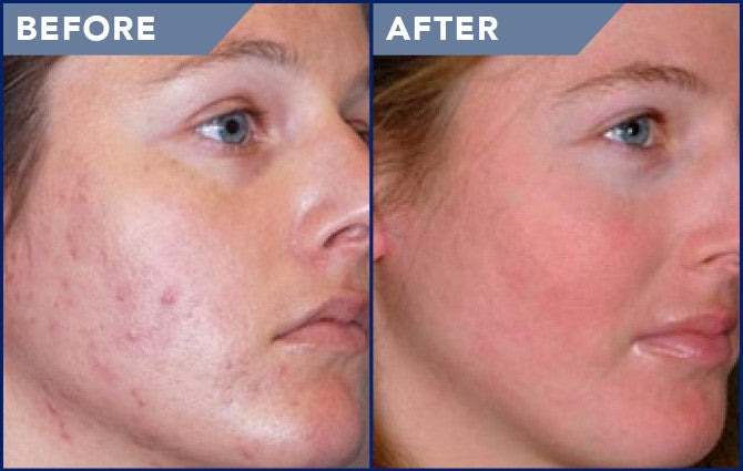 MicroDermabrasion Cloth Erases - Wrinkles, Acne, Scars, Cellulite,