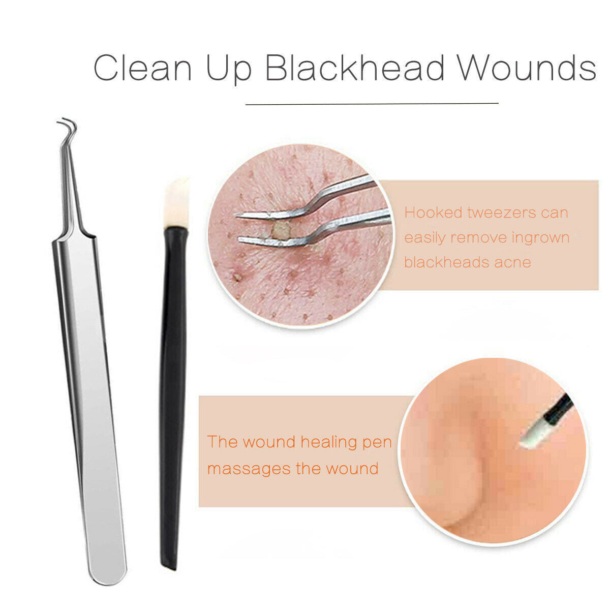 Blackhead Acne Pimple Comedone Spot Extractor Tool Kit - 10 Pcs with Travel Case