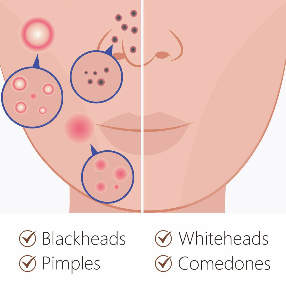 Blackhead and Blemish Removal Kit with Leopard Print Case - 5 Pieces