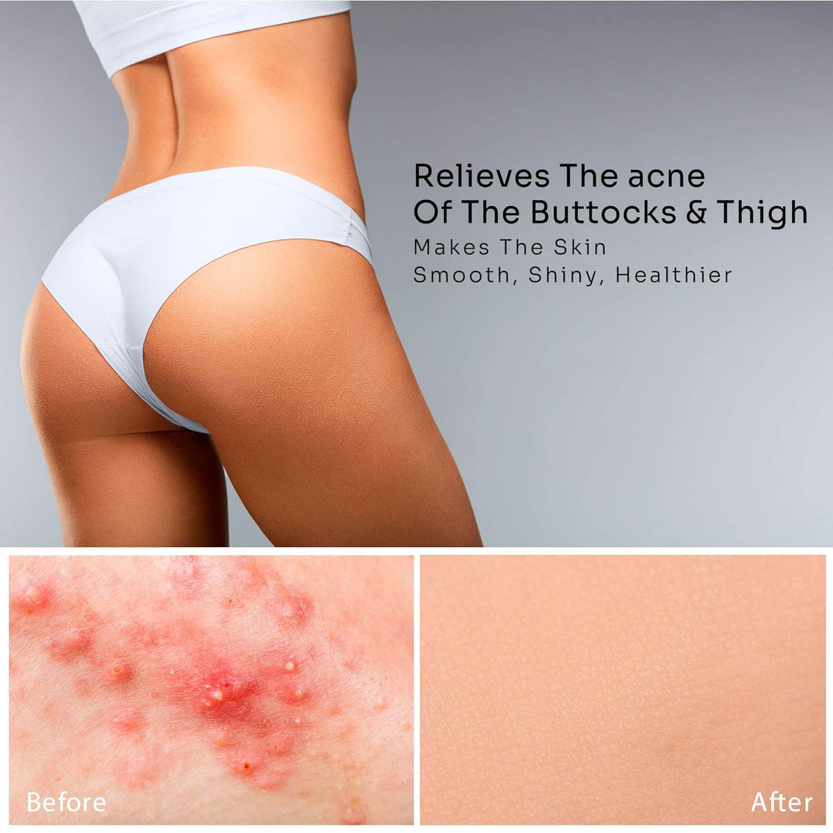 Butt Acne Clearing Treatment with Salicylic Acid & Tea Tree Oil - Gentle Herbal Acne Solution