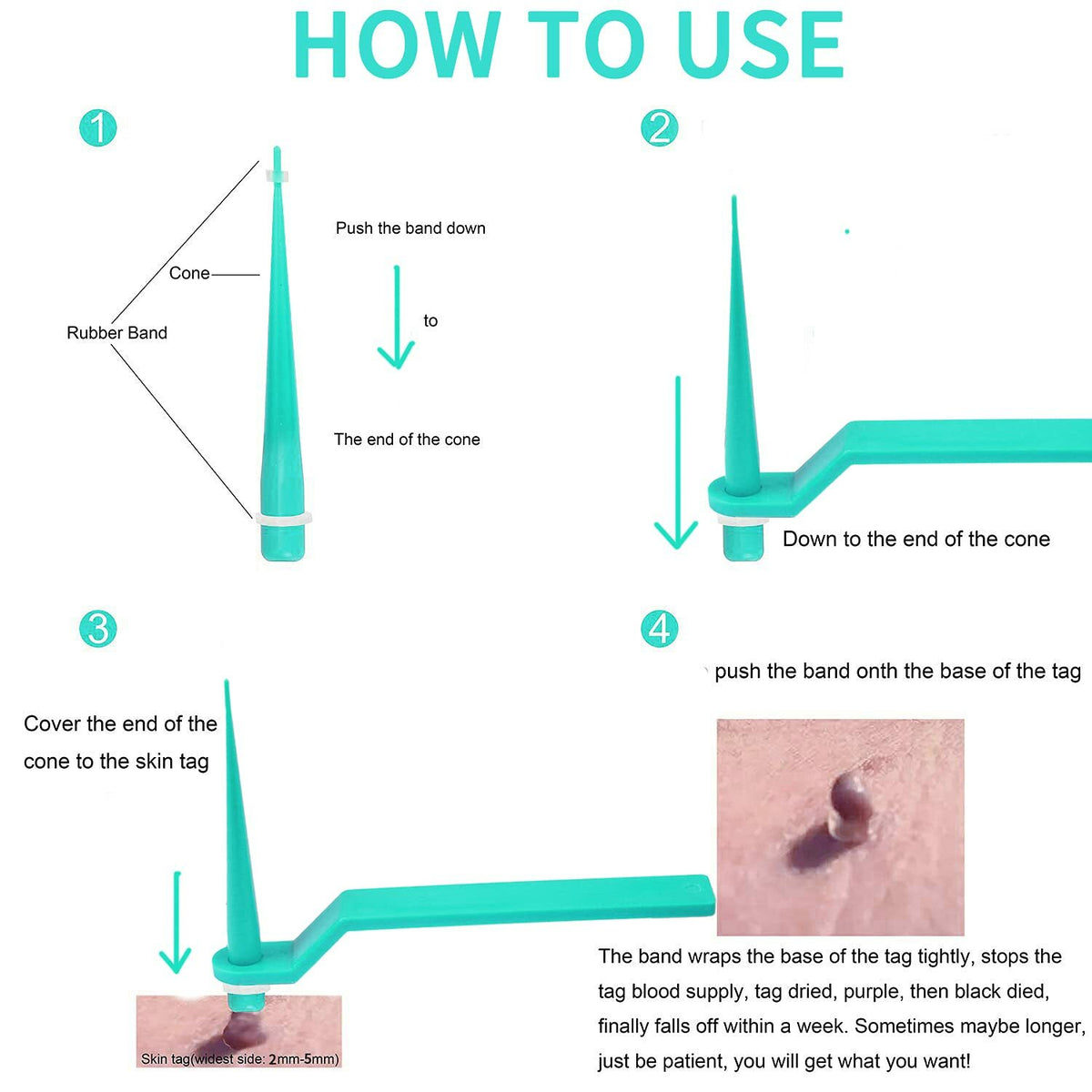 Skin Tag Remover Kit - Painless Wart & Acne Skin Tag Removal Device Set