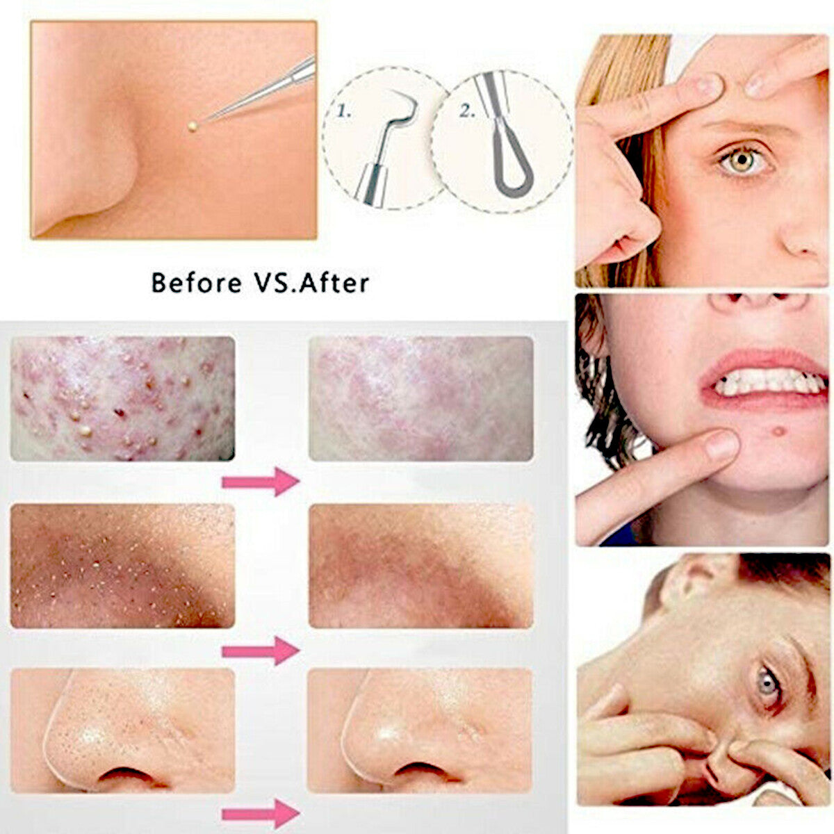 9Pcs Stainless Steel Blackhead & Pimple Extractor Tool Kit with Leather Case