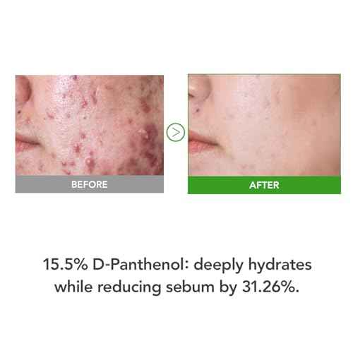 31% Reduction in Sebum & 15.5% High-Dose D-Panthenol ? Calms Redness, Repairs Skin Barrier & Locks in Hydration ? With Heartleaf Extract & Hyaluronic Acid ? Korean Skincare Top Barrier Cream