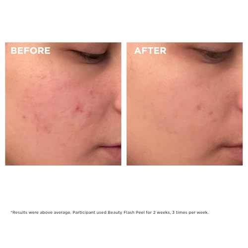 Clarins Beauty Flash Peel | 10-Minute At-Home Facial | Visibly Tightens Pores | Gently Eliminates Dead Skin Cells | Refines Skin Texture | Renews Radiance | Contains AHAs and BHAs | All Skin Types