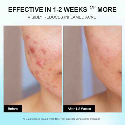 Acne Pimple Spot Treatment Cream: Cystic Hormonal Breakouts Control for Face & Back - 2% Salicylic Acid, Fast Redness Relief, Fades Blemishes & Post-Acne Marks, Teens-Adults, 1.8 oz