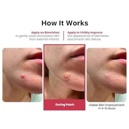 ROSELYNBOUTIQUE Pimple Patches for Face - Hydrocolloid Acne Patches For Zits Blemishes Pore Strips - Vegan Facial Skin Care Products Cruelty-Free (60 Dots)