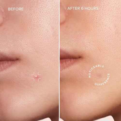 MAREE Star Pimple Patches for Face 2 PACK - Hydrocolloid Acne Patches w/Salicylic Acid, Tea Tree Oil & Centella - Cute Pimple Patches Stars - Teens Zit Patches Stickers - Parches Para Acne - 144 Dots