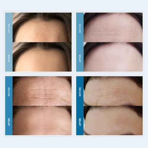 Dersie Silicone Forehead Wrinkle Patches: Overnight Use Forehead Wrinkles Treatment - Reusable Anti Wrinkle Pads for Wrinkles - 3 Patches