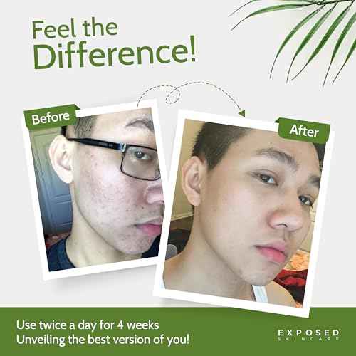 Exposed Skin Care, Basic Acne Treatment Kit with 2.5% Salicylic Acid and 3.5% Benzoyl Peroxide to Clear Up Teen, Adult, Hormonal and Cystic Acne ? Natural, Non-toxic and Cruelty Free