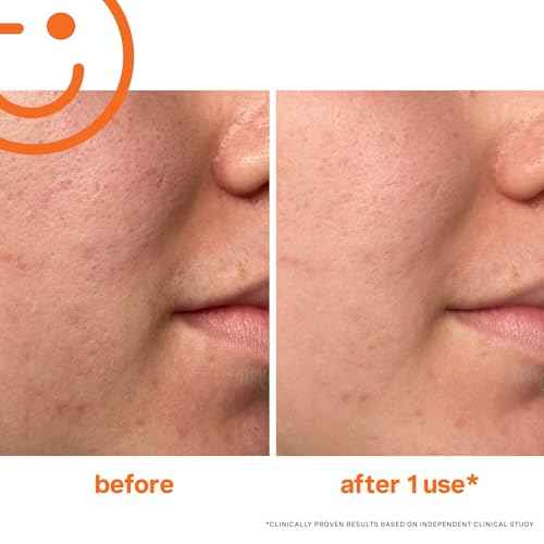 Kate Somerville ExfoliKate Intensive Exfoliating Treatment ? Salicylic Acid and Lactic Acid Super Facial Scrub Improves Texture and Pores