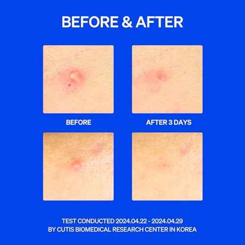 Right Away Thincognito Invisible Spot Patch - Absorbing Hydrocolloid Pimple Patch for Face, Blemishes, Zits, Acne, Breakouts Spot Treatment for Skin Care, 2 Sizes (42 Count)