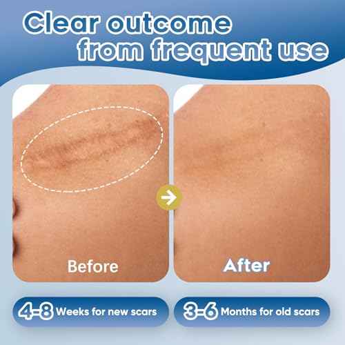 Advanced Silicone Scar Gel for Face & Body ? Silicone Scar Cream for Old & New Scars, Reduces Appearance of Scars from Acne, Surgery, Burns, Injuries, C-Sections & More (1.76 Ounce)
