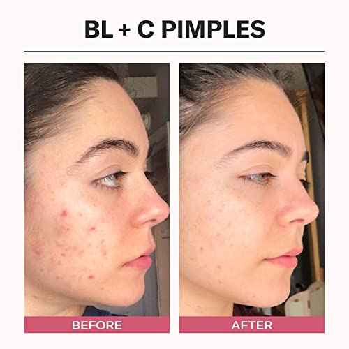 Odacit? Acne Serum Concentrate for Face, Pore Cleanser Facial Oil for Pimples with Black Cumin + Cajeput - Purifying Facial Serum with Vitamin A & Natural Ingredients - 0.17 Fl. Oz