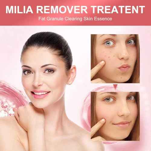 Milia Remover Serum for Eye & Face, Milia Acne Serum for Clear Skin