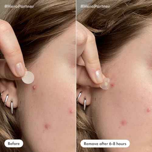 Mighty Patch¢â Day and Night Patches ? The Hydrocolloid Patch Duo Pack. Derm-Tested. Medical-Grade Hydrocolloid. Absorbs Pimple Gunk in 6-8 Hours. 36ct (18x Original, 18x Invisible+)