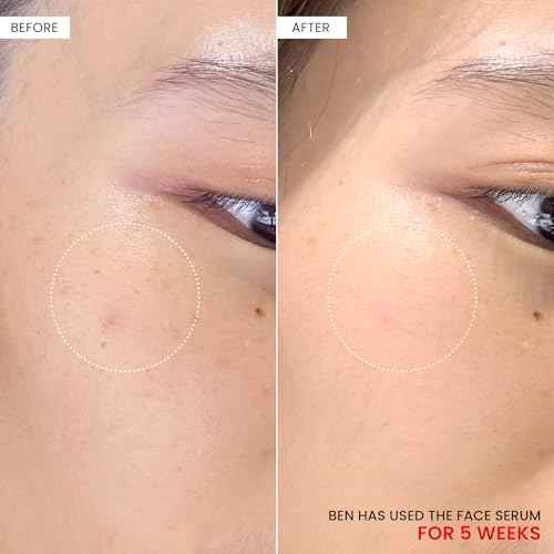 Koji White 2% Kojic Acid Dipalmitate + 3% Tranexamic Acid Serum - Facial Serum for Women, Hydrating with Niacinamide - Vegan, Fragrance-Free, Unscented for Sensitive Skin & Uneven Tone - 1.01 Fl Oz