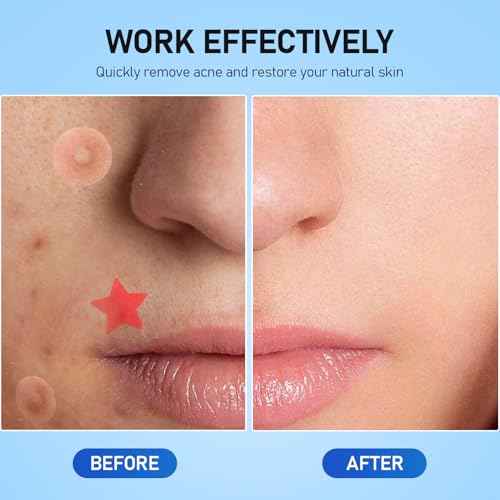 Pimple Patches for Face, 460 Counts Acne Patches, Hydrocolloid Zit Patches with Tea Tree Oil and Salicylic Acid, 4Sizes Cute Star Heart Shaped 11Colors£¨8/10/12/14mm£©