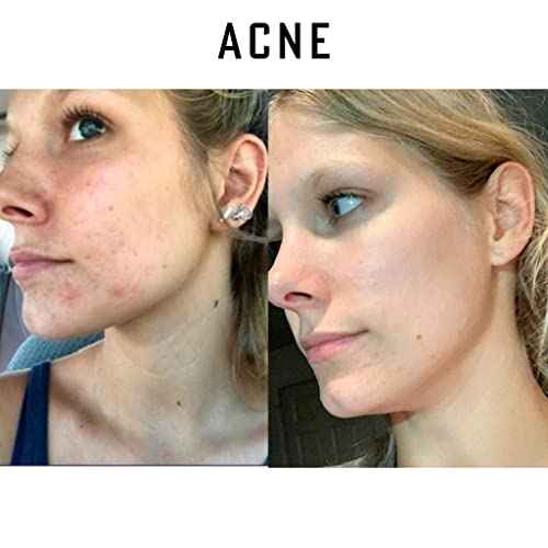 Pure Organic Ozonated Olive Oil Orginal Strength 800 Peroxide For Face and Skin Helps In Acne, Anti-Aging, Wrinkles and Rosacea For Sensitive Skin with Made in Spain