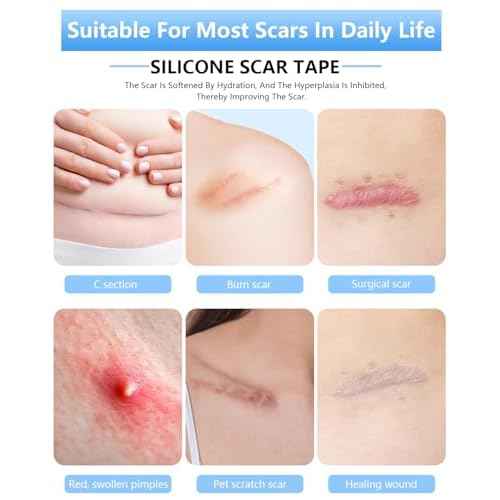 Silicone Scar Sheets, Silicone Scar Tape, 1.6" x 120" Medical Grade Scar Tape Removal Sheets for Surgical, C-Section, Burn Scars (2 Rolls-3M)