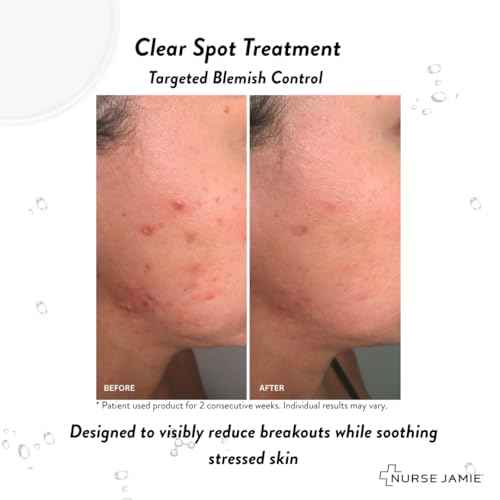 Nurse Jamie Clear Spot Treatment ? Fast-Acting Overnight Blemish Treatment with Salicylic Acid, Glycolic Acid & Sulfur
