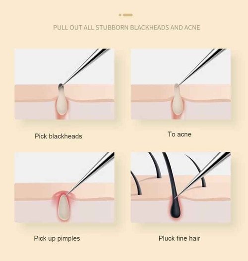 ericotry 1Pcs Stainless Steel Pointed Tweezers Ingrown Hair Tweezer Blackhead Remover Splinter Tweezer