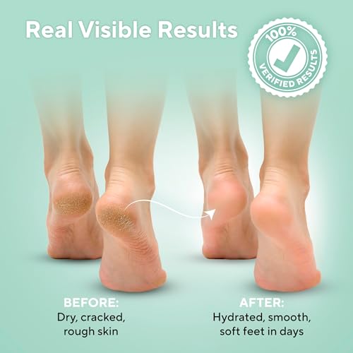 Lavinso Urea Cream 40 Percent for Feet with Maximum Strength - Foot Cream for Calluses and Dry Cracked Heels - Rough Skin Repair for Men and Women