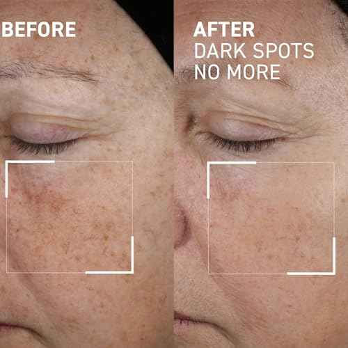 Dr. Brandt Bright This Way Dark Spots No More - Reduces Number, Intensity & Size of Pigmented Spots - 0.5 fl oz
