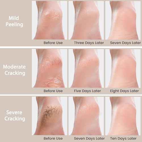 Urea Cream 40 Percent - Foot & Hand Cream for Dry, Cracked Heels, Feet, Knees, Elbows, and Hands - Maximum Strength Urea Lotion for Softening and Moisturizing