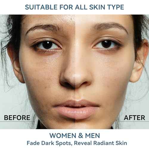 Dark Spot Remover for Face and Body, Dark Spot Corrector Serum, Age Spot & Freckles Remover, Skin Care Serum for Uneven Skin Tone with 360¡Æ Roller Massage Ball, 0.67 fl. oz