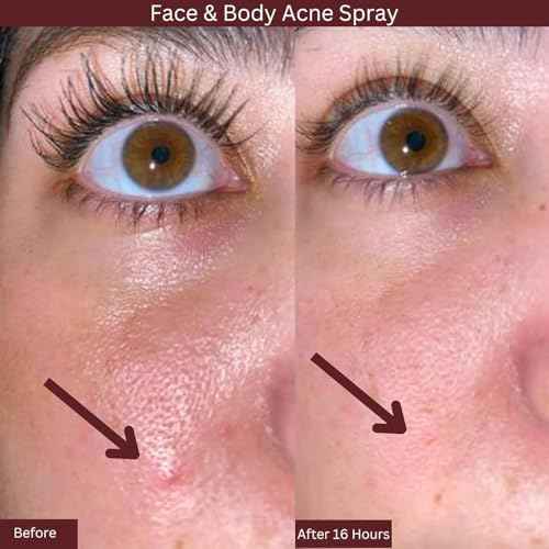 ITK Skincare 2% Salicylic Acid Spray for Face & Body Acne - Blemish-Fighting Treatment for Body Acne, Bacne, Blackheads, Pimples & Blemishes - BHA Blemish Facial Mist Post Workout - 3.3oz Spray Bottle