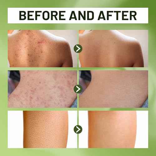 ABERA Folliculitis BHA Shower Gel, High-Performance Folliculitis Body Wash, Wild Bitter Melon Extract, Reduces Bacne & Hyperkeratosis, 3 Boxes + Gifts Combo Grapefruit Hair Regrowth Serum & Shampoo