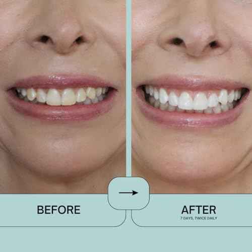 Prostrips - 12 Shades Whiter Teeth - 28 Enamel Safe REMINERALIZING Gentle Strips ? 97% no Sensitivity